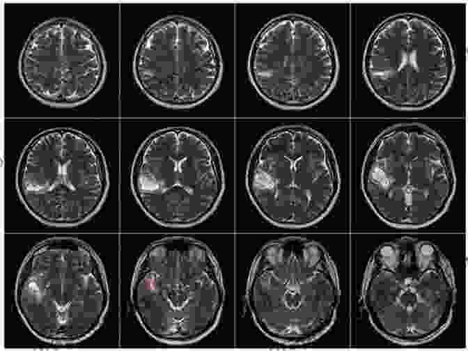 A Magnetic Resonance Imaging (MRI) Scan Of A Craniopharyngioma Tumor In The Brain Craniopharyngiomas Classification And Surgical Treatment (Frontiers In Neurosurgery 4)