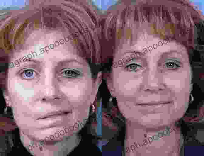 A Person With Facial Paralysis On One Side Of Their Face. Facial Palsy: Techniques For Reanimation Of The Paralyzed Face