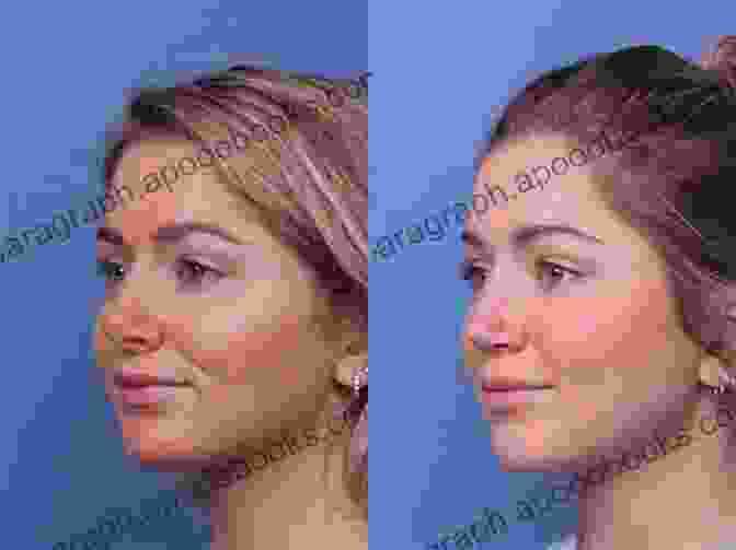 Before And After Rhinoplasty Surgery Dallas Rhinoplasty: Nasal Surgery By The Masters