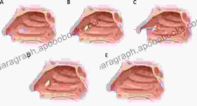 Modified Inferior Turbinoplasty Surgical Procedure Modified Inferior Turbinoplasty: A New Surgical Approach