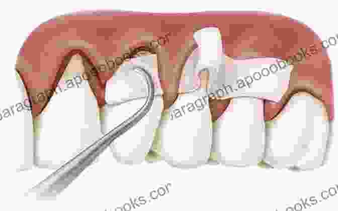 Treatment Options For Gingival Recession Gingival Recession Management: A Clinical Manual