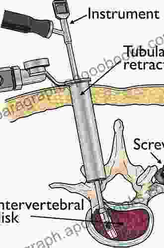 Minimally Invasive Spine Surgery Techniques